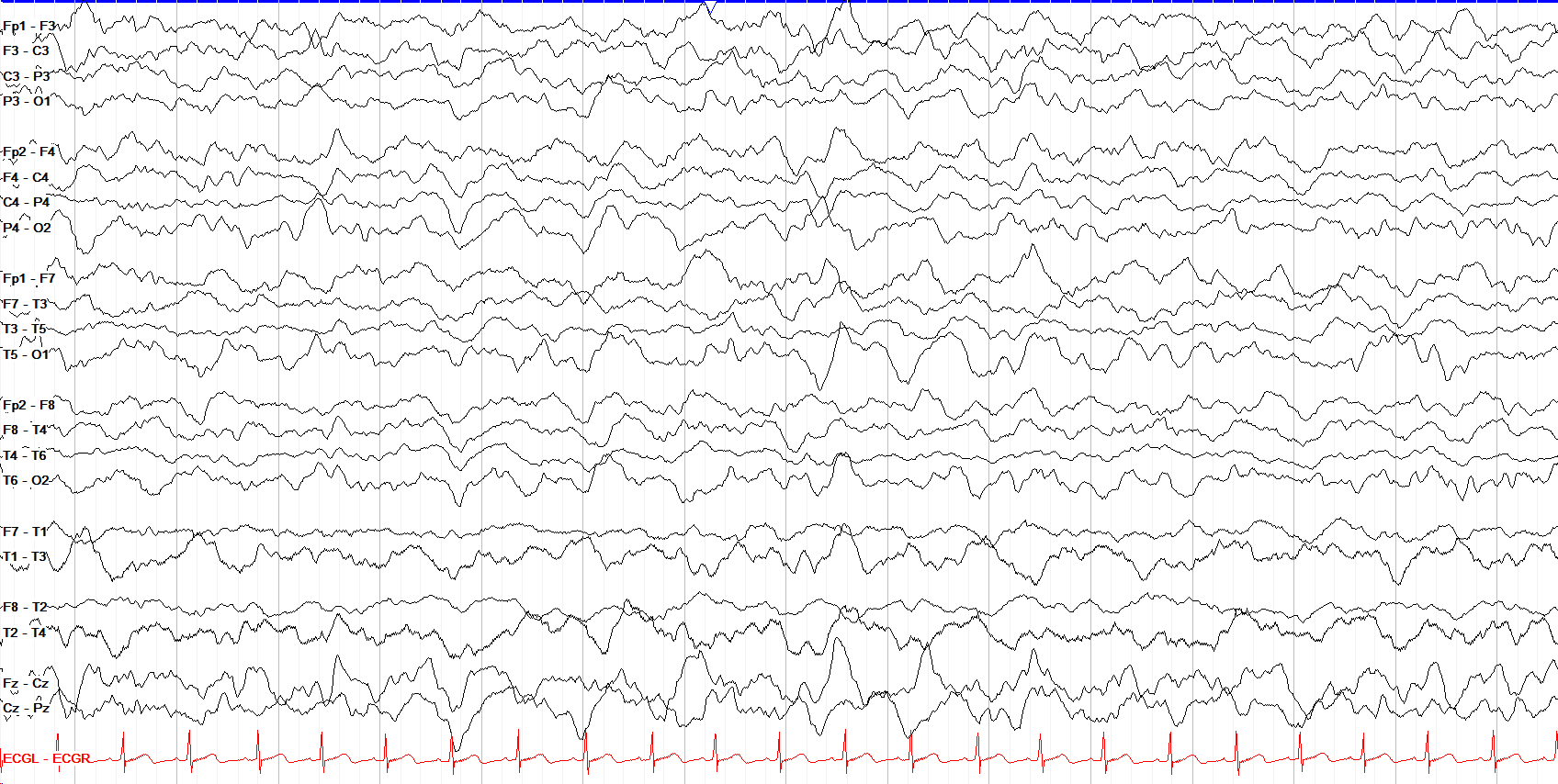 Slow wave sleep